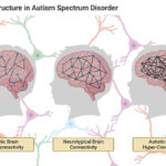 brain structure in autism spectrum disorder