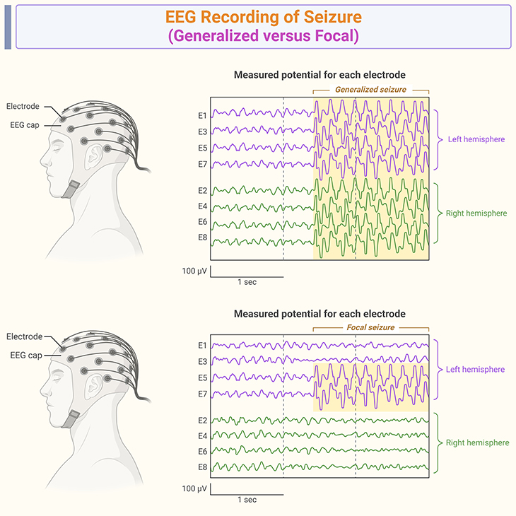 EEG Recording of Seizure - Generalized versus Focal